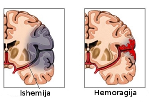 hemoragija-vs-ishemija2